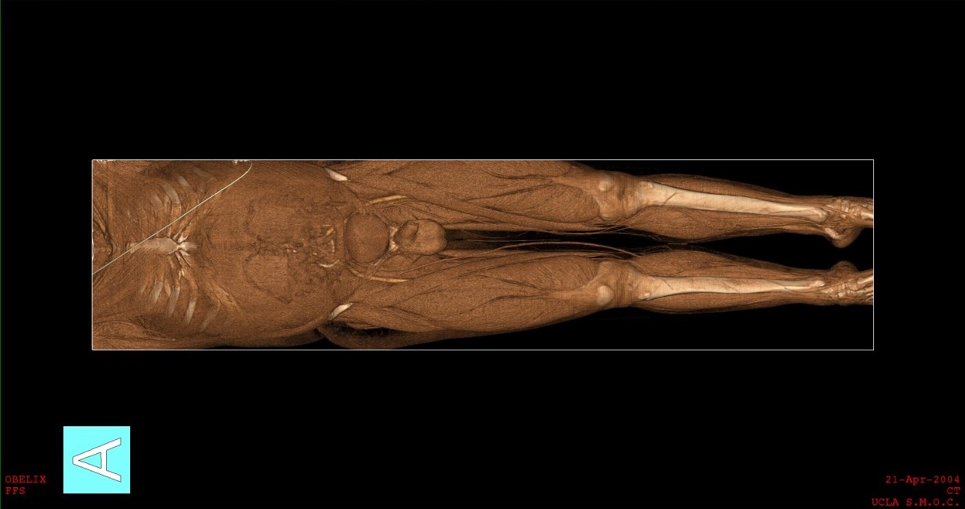Virtual NoCut Autopsy for Forensic Medicine Experts